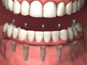 Personas mayores pagan esto por los implantes dentales de boca completa (Medicare puede ayudar)